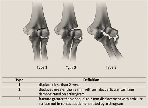 Distal Humerus Fractures Lateral Condylar Fracture Sexiz Pix