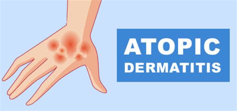 Atopic Dermatitis Causes Symptoms Diagnosis And Treatment
