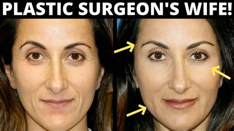 Facial Fat Transfer Before And After Look 10 Years Younger With Facial Fat Transfer Youtube