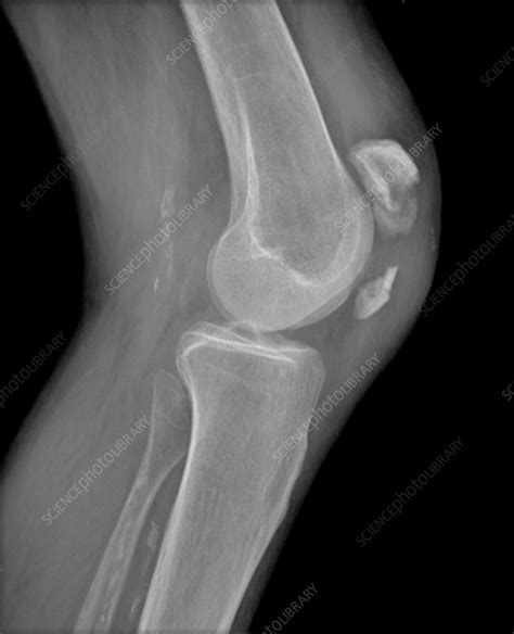 knee cap fracture x ray stock image c014 7045 science photo library