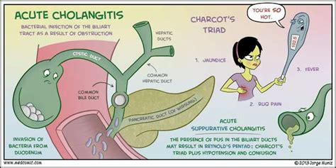 Acute Cholangitis And Acute Suppurative Cholangitis Triad Med Surg