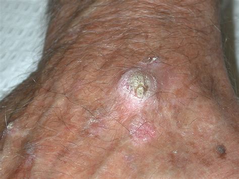 Invasive Squamous Cell Carcinoma Skin Cancer Pictures