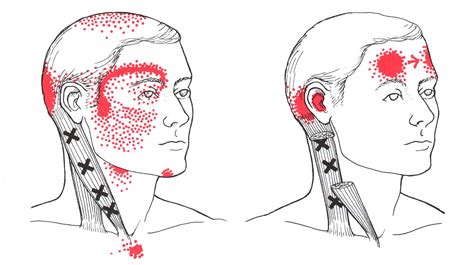 Sternocleidomastoid The Trigger Point And Referred Pain Guide