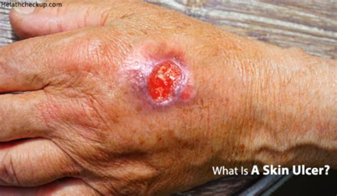 Skin Ulcer Types Causes Symptoms Stages Treatment