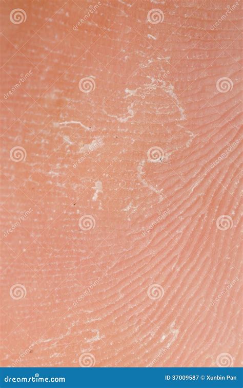 Dry Skin Texture Stock Image Image Of Hyperkeratosis 37009587