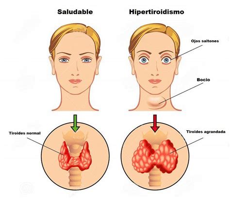 Hipertiroidismo O Que Causas Sintomas E Diagn Stico Conhecer Para
