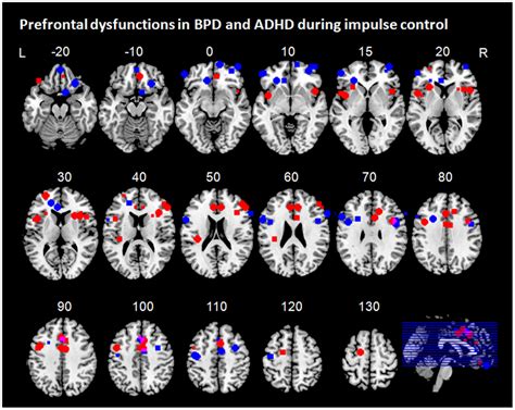 Frontiers Frontal Dysfunctions Of Impulse Control A Systematic