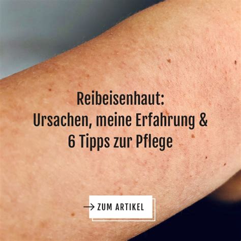 Reibeisenhaut Erfahrung And 6 Hilfreiche Tipps Zur Behandlung