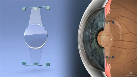 Icl Implantable Collamer Lens Cure Sight Laser Center