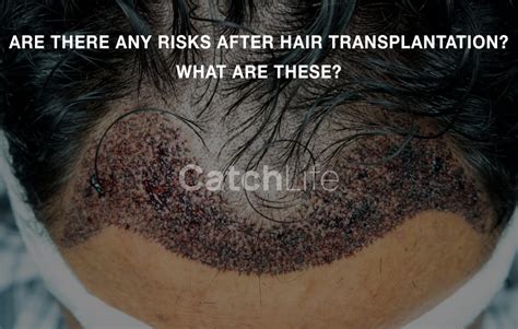Are There Any Risks After Hair Transplantation What Are These
