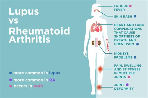 Lupus Vs Rheumatoid Arthritis Whats The Difference Creakyjoints