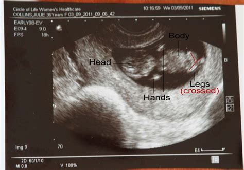Ultrasound Pictures At 7 Weeks Search Results Calendar 2015