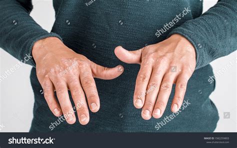 Man Sick Hands Dry Flaky Skin Stockfoto 1582259803 Shutterstock