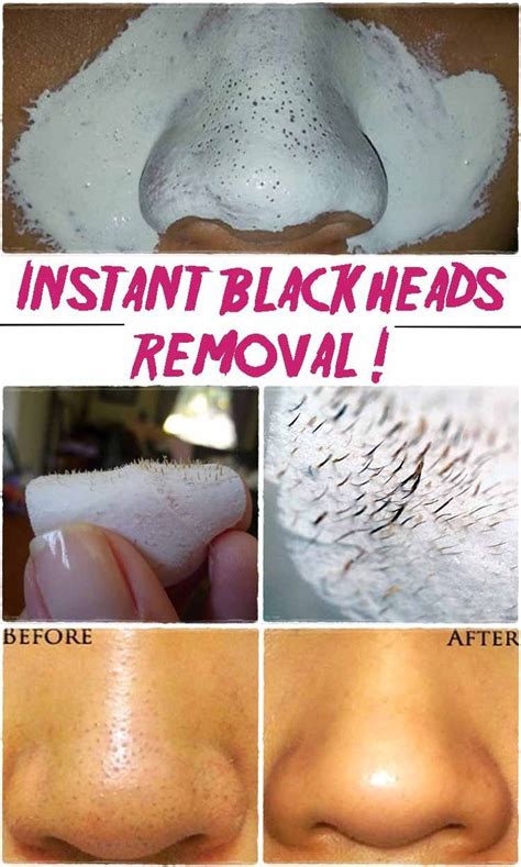 Clearing Blackheads After Rhinoplasty A Complete Guide Justinboey