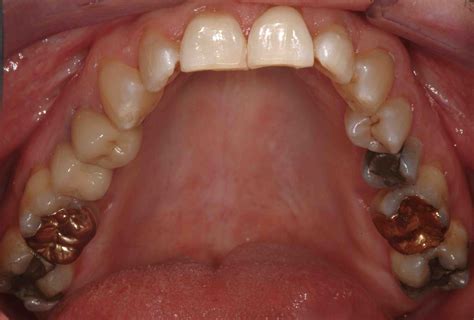 Occlusal Surface Teeth
