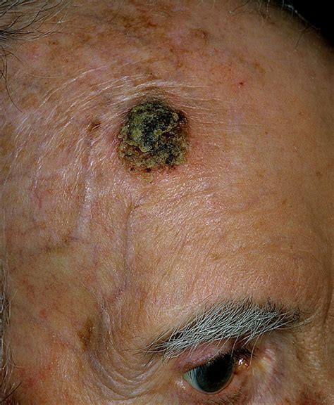 Skin Cancer Sores On Head Prnso