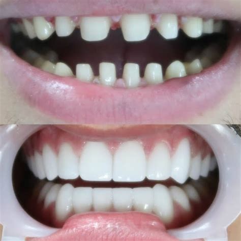 Teeth Shaving Before And After