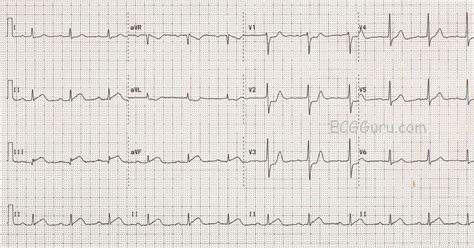 12 Lead Ecg Case Is This A Stemi
