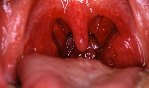 Symptoms of advanced tonsil cancer can include: Can Tonsillitis Be Mistaken For Throat Cancer - Cancer ...