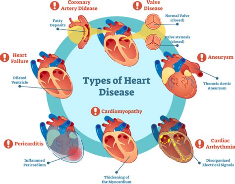 Everything You Need To Know About Heart Disease Mamelodi Tv