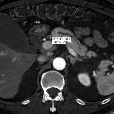 Example Of Measurement Of Density Hu Of A Porto Caval Lymph Node From