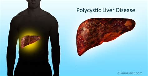 Learn more about polycystic liver disease (pld), possible causes, symptoms, signs, diagnosis, treatment. Polycystic Liver Disease (PLD): Causes, Symptoms, Treatment