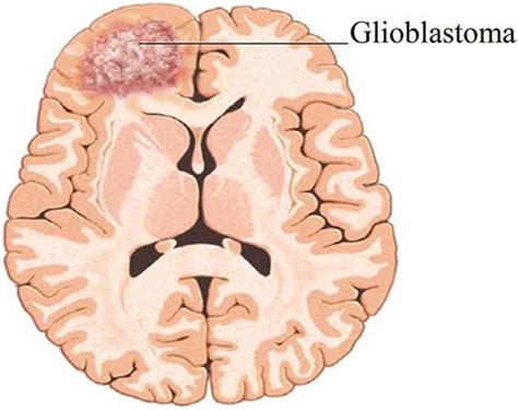 Deep Belief Networks Detect Glioblastoma Tumor South Ural State