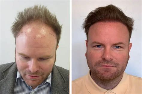 Hair Transplant Cheap Rates 5500 Amazing Results