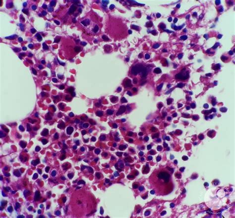 After the surgery, you might feel tired or weak and have trouble walking for a few days. Immune thrombocytopenic purpura (ITP) bone marrow biopsy ...