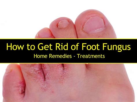 How To Get Rid Of Foot Fungus Home Remedies Treatments