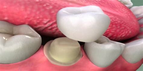 Costs range from $500 to $1,500 per tooth. Dental Crown Cost - in 2021