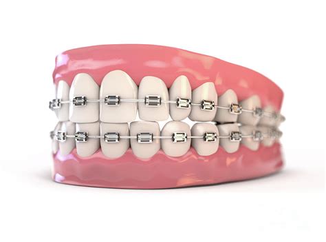 Fake Teeth Set With Braces Digital Art By Allan Swart Fine Art America