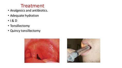 Tonsillitis Quinsy And Adenoiditis