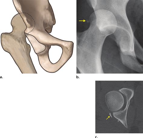 A Drawing Shows The Typical Appearance Of Posterior Hip Dislocation