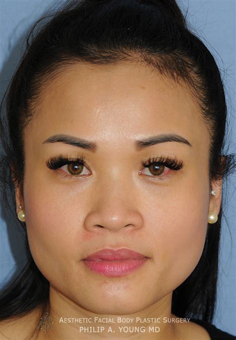 Asian Facial Plastic Surgery Seattle Bellevue