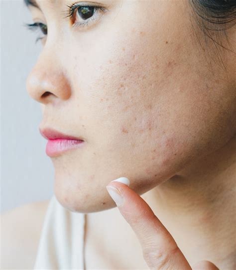 Acne Scar Treatment And Removal In Westerville Oh
