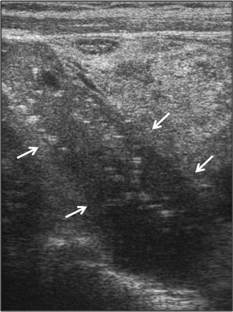 Ultrasound Image Of A Parathyroid Carcinoma The Tumor Arrows