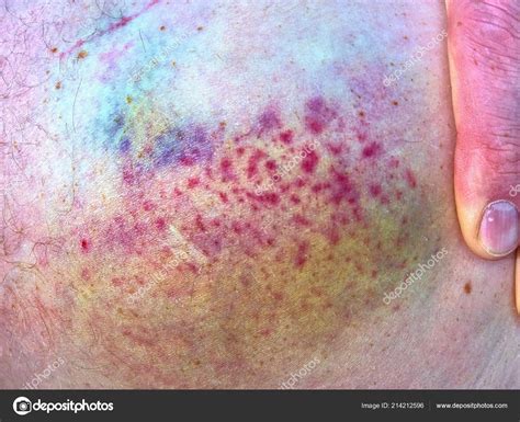 Purple Bruise Affected Skin Close View Colorful Hematoma Large Bruises