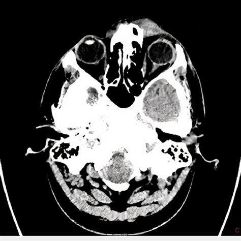Computed Tomography Ct Of The Head With Contrast Showing A