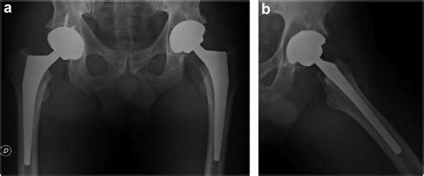 Ap A And L B Radiographs Of The Left Hip Show A Well Fixed And