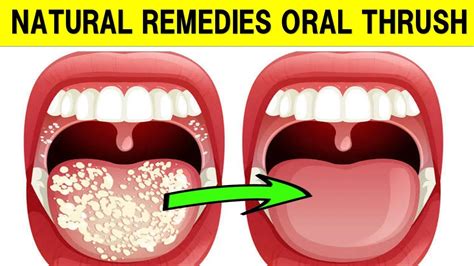 How To Treat Oral Thrush With Natural Remedies Epic Natural Health