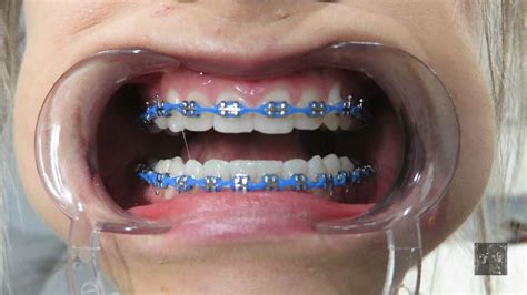 Braces Braceface Powerchain Metalbraces Girlswithbraces マルシェバッグ