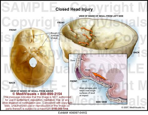 Closed Head Injury Medical Illustration Medivisuals