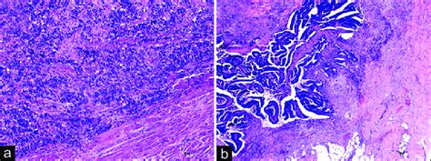 A Poorly Differentiated Endometrial Adenocarcinoma H And E ×10 Download Scientific