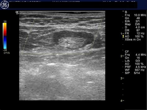 Ultrasound Imaging Normal And Enlarged Lymph Nodes