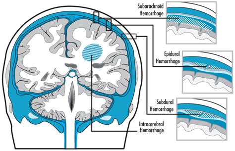 Traumatic Brain Injuries And Hematomas