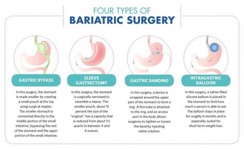 How To Choose The Best Type Of Bariatric Surgery Women Fitness Mag