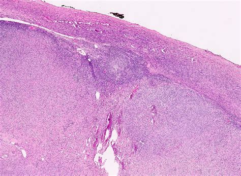 Ovarian Thecoma Ultrasound