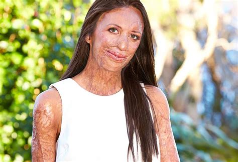 Inspirational Burns Victim Turia Pitt Recovering From Reconstructive Nose Surgery Now To Love