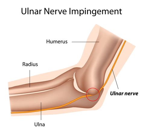 Ulnar Nerve And Cubital Tunnel Syndrome Precision Oral Surgery